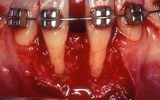 Dental instruments